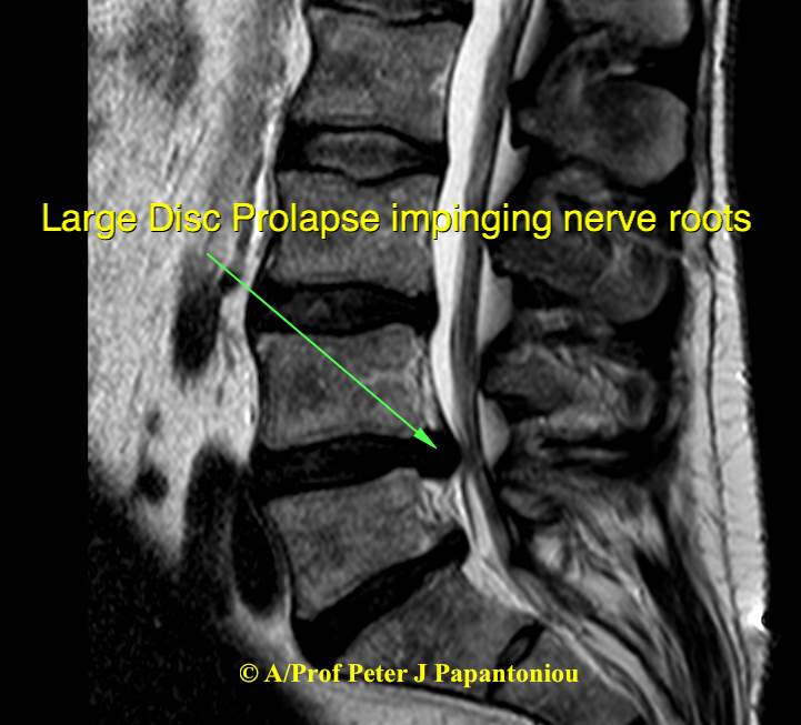 Large Disc Prolapse sagittal 2